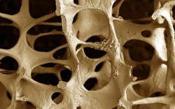 osteoporosiiii
