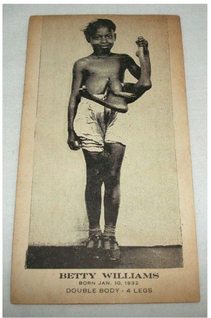 Η Betty Lou Williams γεννήθηκε το 1932 στη Τζώρτζια των ΗΠΑ με 4 πόδια, δύο από τα οποία εξείχαν από την κοιλιά της. Θεωρείται ως η καλύτερα αμοιβόμενη άνθρωπος-αξιοθέατο όλων των εποχών. Πέθανε το 1955 από άσθμα.