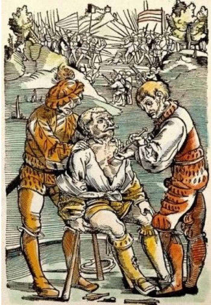 Στρατιωτικός χειρουργός που προσπαθεί να αφαιρέσει βέλος από το στήθος στρατιώτη, δίπλα στο πεδίο της μάχης, στη Γερμανία του 16ου αιώνα…