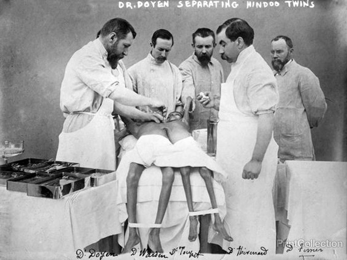 Ο Γάλλος χειρουργός Dr. Eugne-Louis Doyen το 1902 πραγματοποιεί επείγουσα επέμβαση διαχωρισμού των Ινδών σιαμαίων Radica και Doodica, ενώ το ένα κορίτσι είχε προσβληθεί από φυματίωση, με την ελπίδα να σωθεί το δεύτερο.